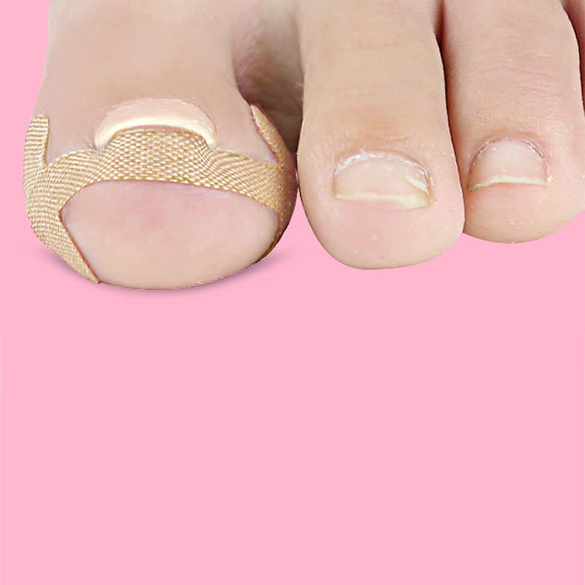 Ingrown Toenail Corrector Toe Nail Strips Patch Pedicure Brace Foot